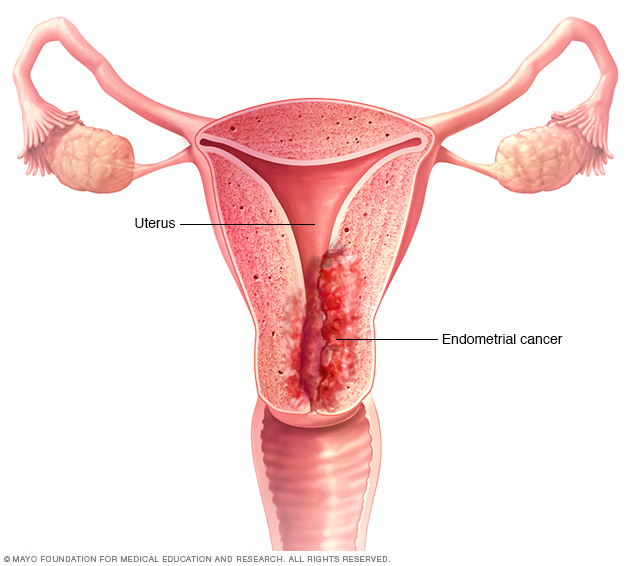 Uterine cancer Photo